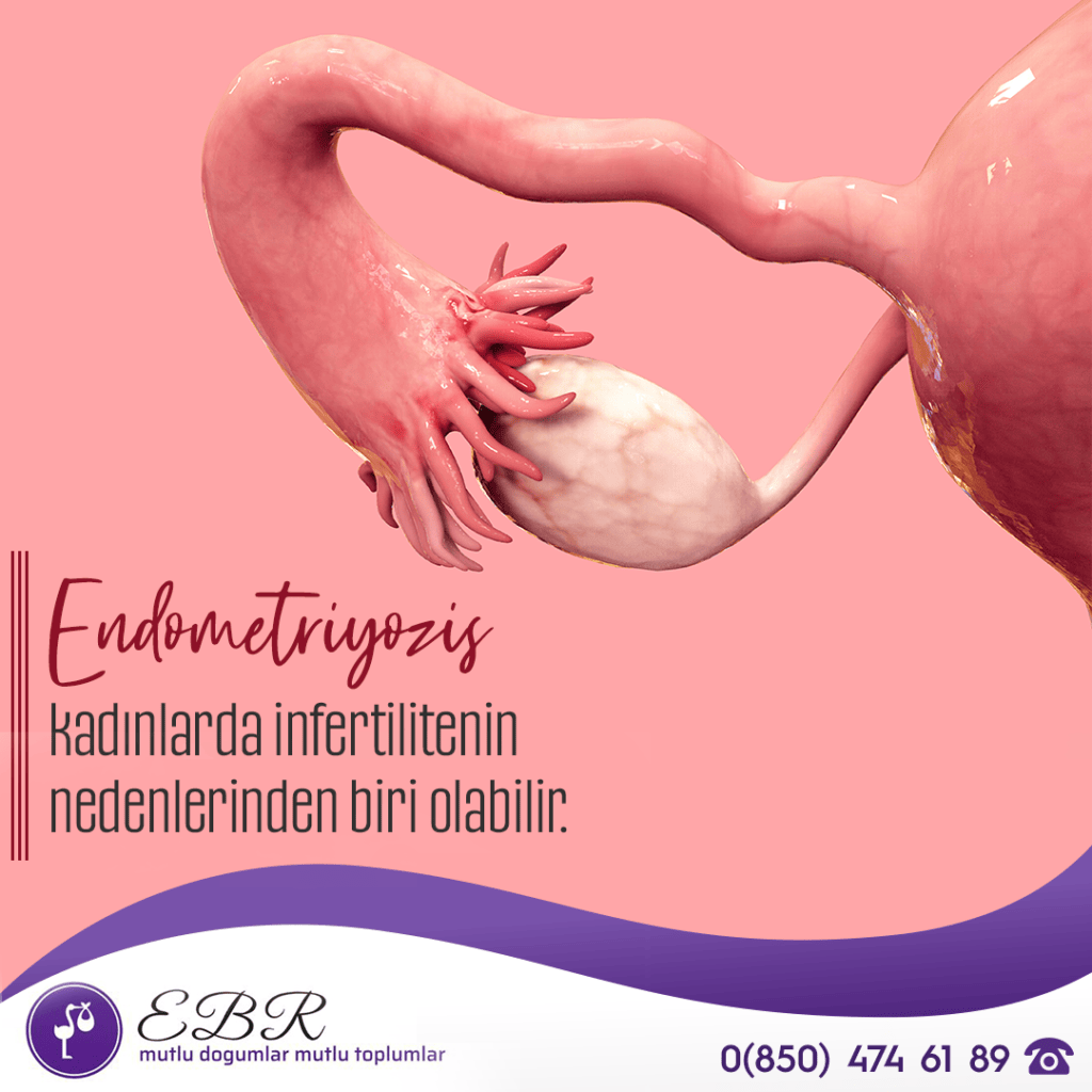 Endometriyozis, kadınlarda infertilitenin nedenlerinden biri olabilir